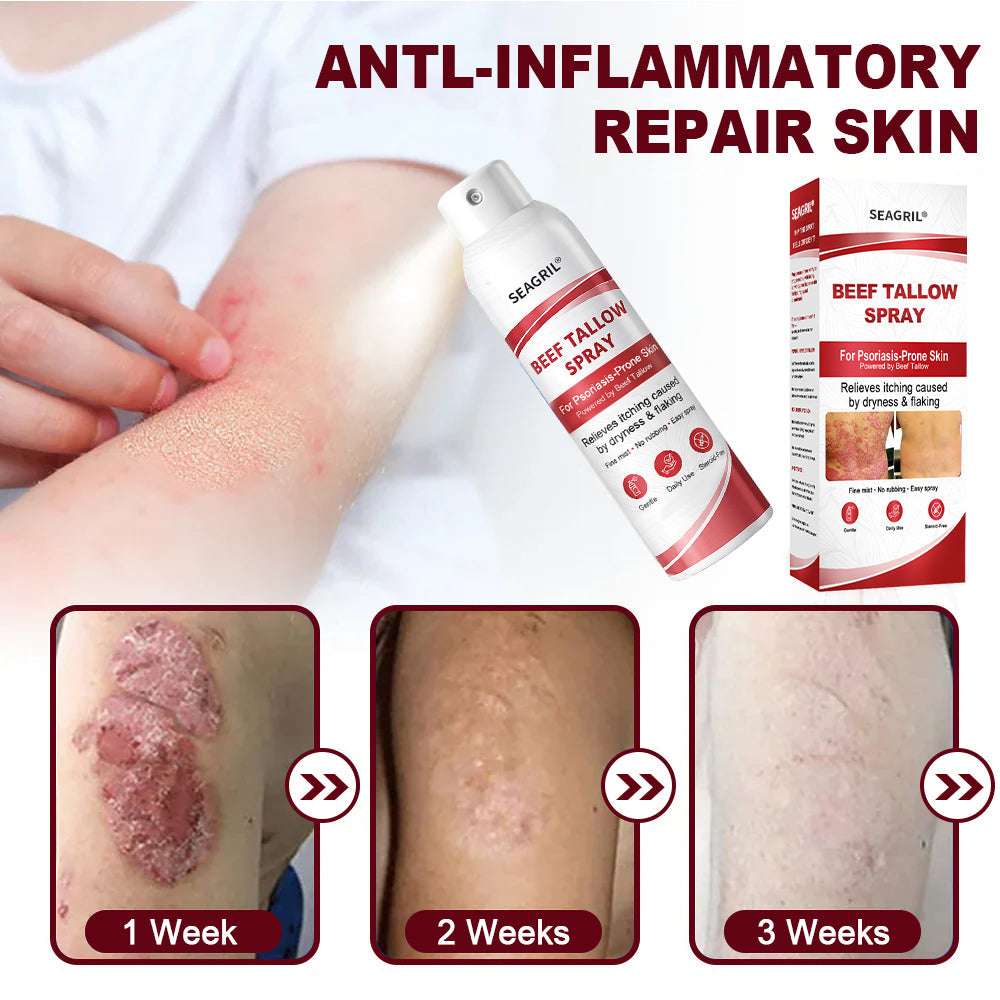 SEAGRIL® Beef Tallow Spray for Itchy, Flaky Psoriasis Skin 1