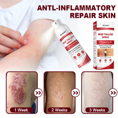 SEAGRIL® Beef Tallow Spray for Itchy, Flaky Psoriasis Skin 1